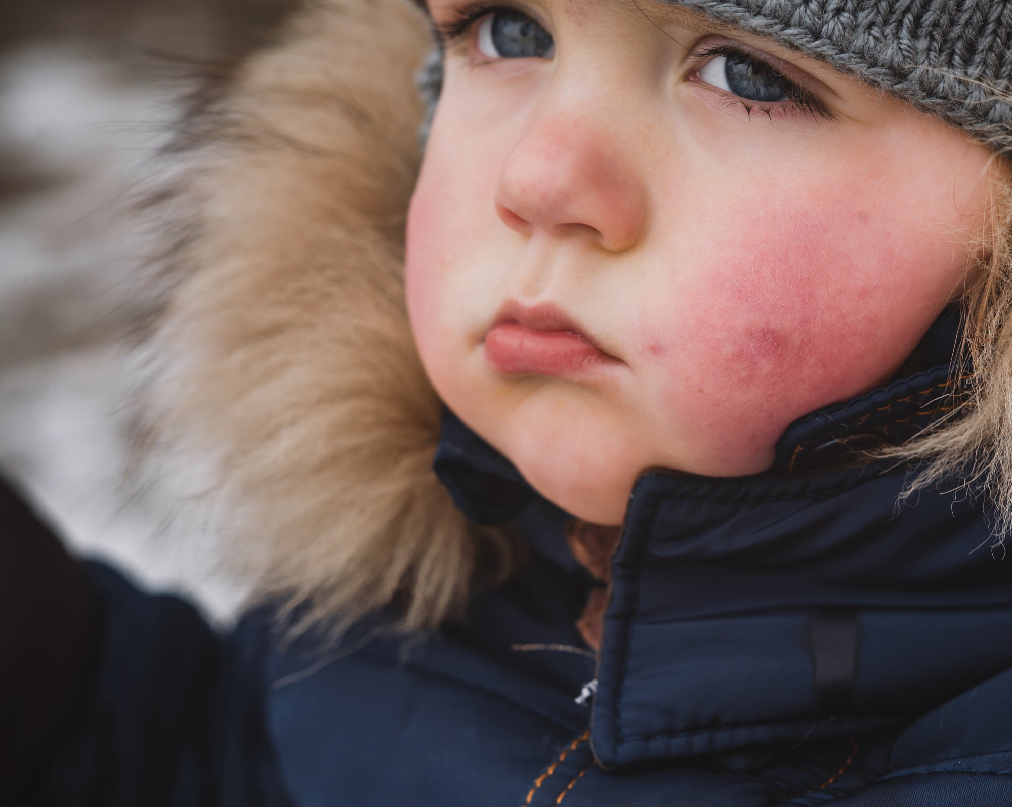 Winter Skin Tips for Managing Eczema