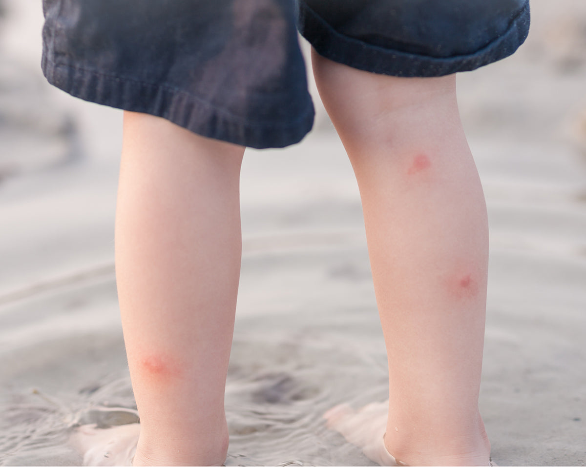 Child's legs with bug bites